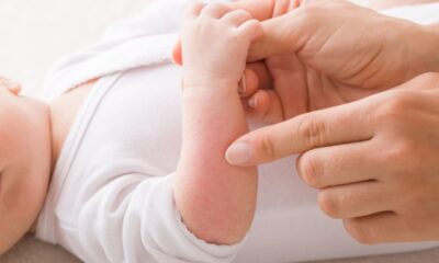 Eruzione cutanea neonato