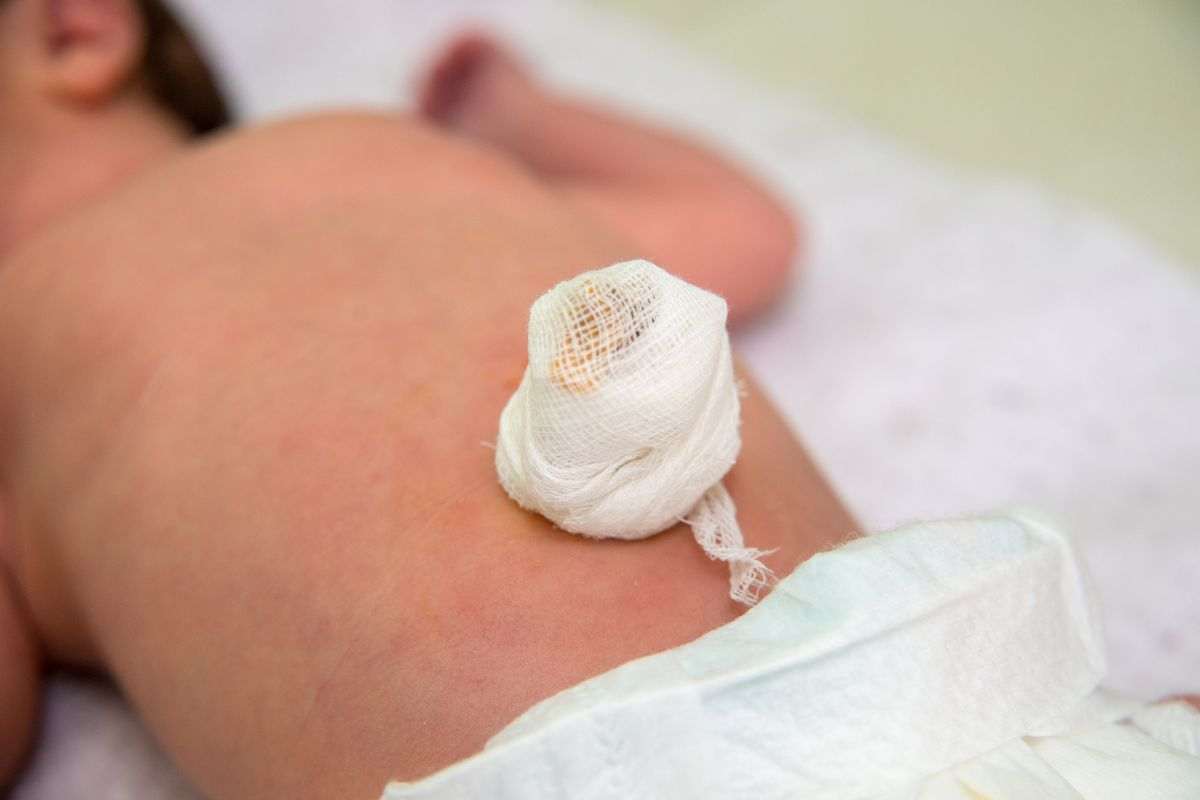 neonato ernia ombelicale