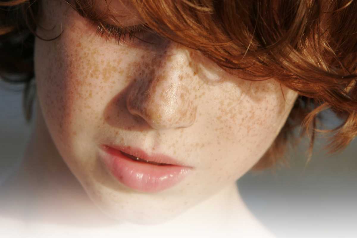Varianti lentiggini bambini